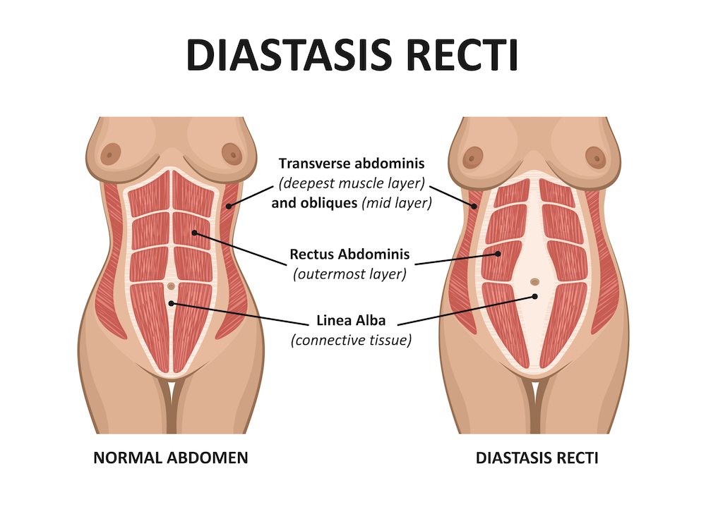 Do I have Diastasis Recti or is it a hernia? Risk factors for Both:  ✓Obesity ✓Multiple pregnancies ✓Previous abdominal surgery