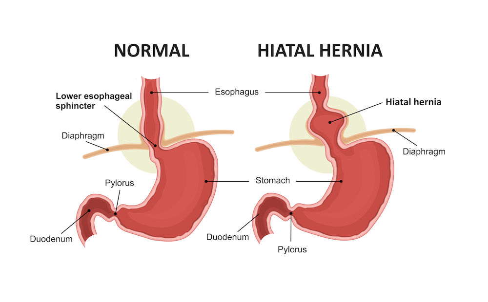 Hiatal hernia and normal anatomy of the stomach