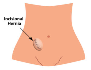 incisional hernia. intestinal hernia. Infographics. Vector illustration on isolated background
